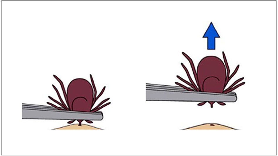 Instructies voor het verwijderen van een teek: